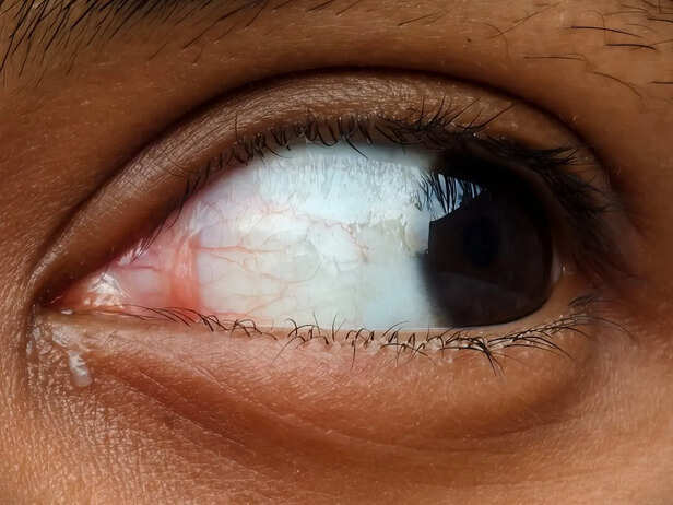 Close-up of red and irritated human eyes