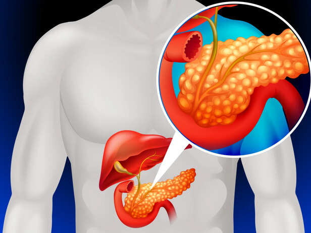 Blood Test for Pancreatic Cancer