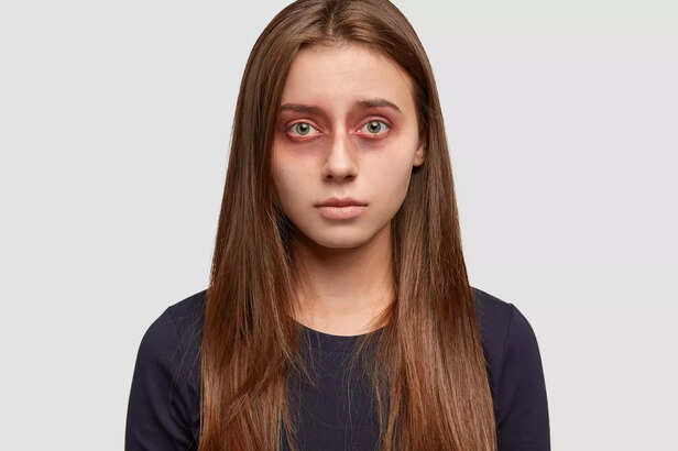 Remove Dark Circles Quickly and Permanently