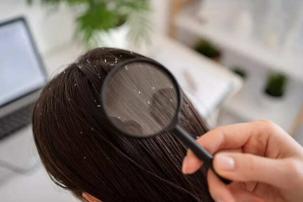 What is Dandruff
