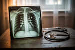Tuberculosis Symptoms: Do